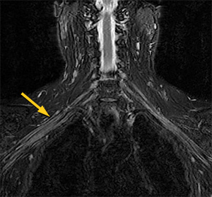 brachial plexus anatomy mri