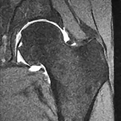 Hip Arthrogram