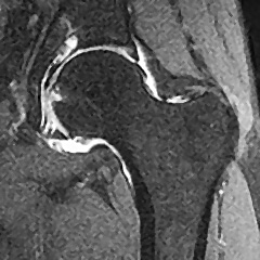 Hip arthro with Rheumatoid Arthritis