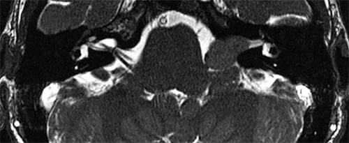 Large Acoustic Neuroma
