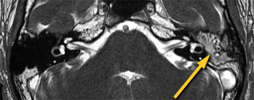 Cholesteatoma