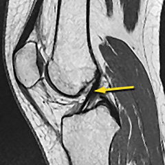 Knee MRI showing ACL