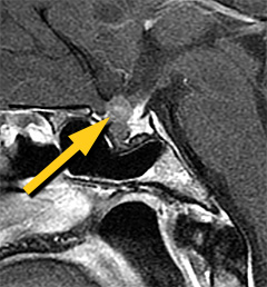 Rathkes Cyst