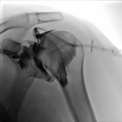 Shoulder Arthro X-Ray