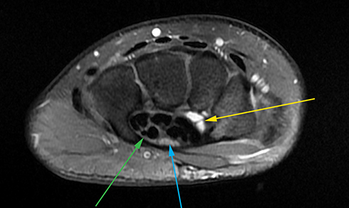 Wrist cyst