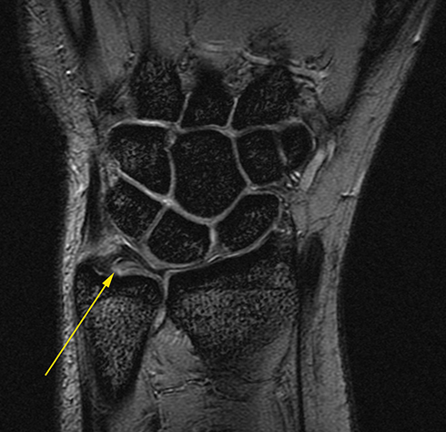 wrist ligaments mri