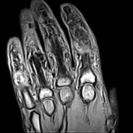 Hand MRI
