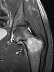 Hip Osteonecrosis