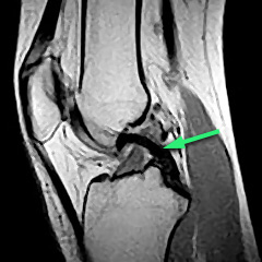 Knee MRI showing PCL