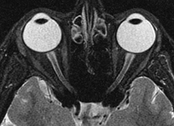 normal optic nerve mri